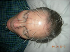 Acupuncture Face Lift
